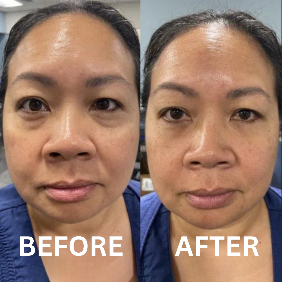 Collagen Eye Patches