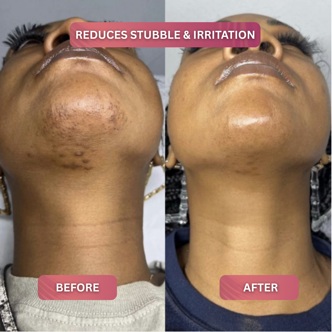 Cyperus Rotundus Skin Serum